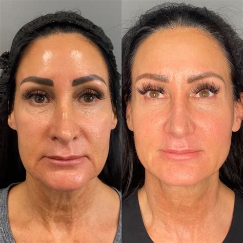 RADIESSE – Profyskin.